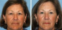 63 year old woman treated with upper & lower blepharoplasty, Lux2940 laser skin resurfacing