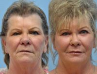 64 year old woman treated for fine lines and skin laxity