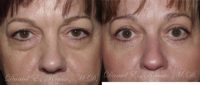 55-64 year old woman treated with Eyelids Surgery