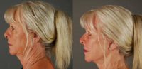 65-74 year old woman treated with MACS Facelift