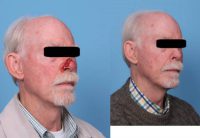 65-74 year old man treated with Mohs Surgery