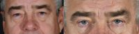 66 year old man treated with Upper Eyelid Surgery