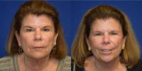 65-74 year old woman treated with Lip Surgery