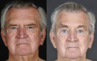 67 year old man treated with Brow Lift and Upper Blepharoplasty