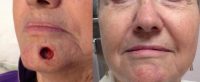 65-74 year old woman treated with Facial Reconstructive Surgery