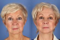 70 year old woman treated with Facelift and Necklift