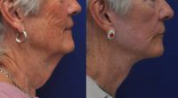 72 Year Old Female Treated for Aging Neck