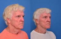 65-74 year old man treated with Facelift
