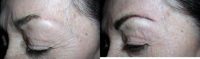 75 and up year old woman treated with Permanent Makeup