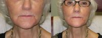 76 year old lady with restylane to corners of mouth