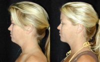 Liposuction of the Chin