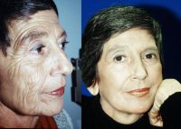 Challenging anti-aging combo case