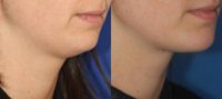 Chin Implant and Submental Liposuction