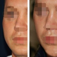 Cosmetic Surgery For Nose Candidate By Dr Shahram Shahidi, BSc, MBBS, FRACS, Woollahra Facial Plastic Surgeon, Specialist In Otolaryngology – Head And Neck Surgery