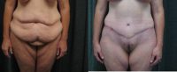 Dermolipodystophy of the abdomen and breast ptosis post 200lb weight loss