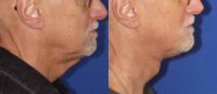 Direct Neck Lift in a Man