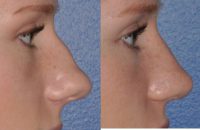 Rhinoplasty for Improved Profile and Nasal Tip