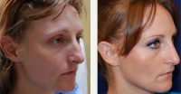 Doctor Anand G. Shah, MD, San Antonio Facial Plastic Surgeon - 28 Year Old Woman Treated With Rhinoplasty