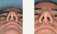 Doctor Anthony Bared, MD, FACS, Miami Facial Plastic Surgeon - 31 Year Old Woman Treated With Rhinoplasty