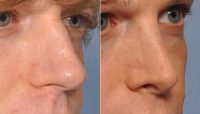 Doctor Barry L. Eppley, MD, DMD, Indianapolis Plastic Surgeon - 36 Year Old Transgender Female Treated For Nasal Reshaping