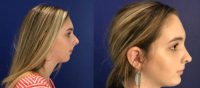 17 year old woman treated with Rhinoplasty