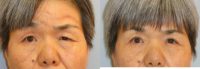 65-74 year old woman w/ facial paralysis s/p blepharoplasty and direct browlift