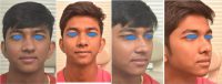 Doctor Brajendra Baser, MS, DNB, India Facial Plastic Surgeon - 24 Year Old Man Treated With Rhinoplasty