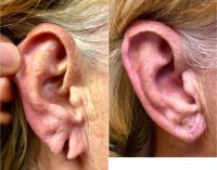 Ear lobe repair 1 week postop