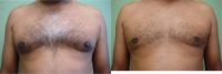 35-44 year old woman treated with Male Breast Reduction