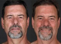 55-64 year old man treated with Brow Lift and Upper Blepharoplasty