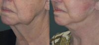75 and up year old woman treated with Deep Plane Facelift