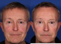 60 year old man treated with Eyelid Surgery