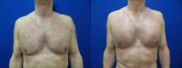 46 year old man treated with Pec Implants