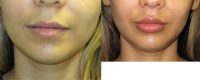 25-34 year old woman treated with Upper Lip Lift