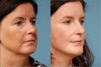 Face lift, Endoscopic Brow lift, Chin Augmentation and Upper Blepharoplasty