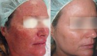 35-44 year old woman treated with MicroLaser Peel