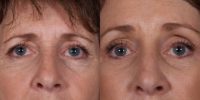 55-64 year old woman treated with Brow Lift