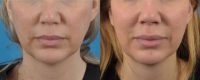 35-44 year old woman treated with Fillers: Juvederm Volbella