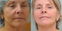 55-64 year old woman treated with Facelift and Laser Resurfacing