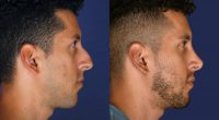 25-34 year old man treated with Injectable Fillers