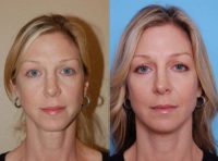 35-44 year old woman treated with Cheek Augmentation