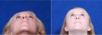 Doctor Ivan Wayne, MD, Oklahoma City Facial Plastic Surgeon - 21 Year Old Woman Treated With Rhinoplasty