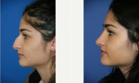 Doctor James Murphy, FRCS(Plast), Manchester Plastic Surgeon - 23 Year Old Woman Treated With Rhinoplasty
