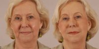45-54 year old woman treated with Dermal Fillers and Injectables