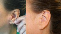 45-54 year old woman treated with Ear Lobe Surgery