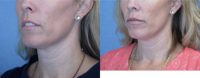 34 year old woman treated with Lip Augmentation