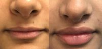 18-24 year old woman treated with Lip Lift