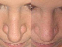 35-44 year old woman treated with Revision Rhinoplasty