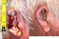 45-54 year old man treated with ear reconstruction after removal of cancer.