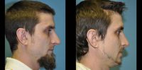 25-34 year old man treated for Nose Surgery